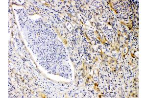 PRKAR1A was detected in paraffin-embedded sections of human intestinal cancer tissues using rabbit anti- PRKAR1A Antigen Affinity purified polyclonal antibody (Catalog # ) at 1 µg/mL.