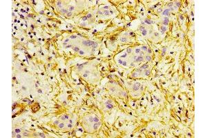 IHC image of ABIN7143132 diluted at 1:300 and staining in paraffin-embedded human liver cancer performed on a Leica BondTM system.