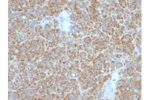 Formalin-fixed, paraffin-embedded human Melanoma stained with Bcl-2 Monoclonal Antibody (BCL2/782 + BCL2/796). (Bcl-2 anticorps)