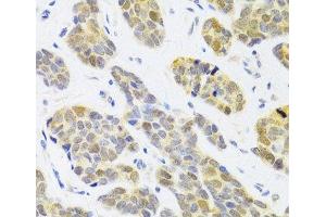 Immunohistochemistry of paraffin-embedded Human breast cancer using RFC4 Polyclonal Antibody at dilution of 1:100 (40x lens). (RFC4 anticorps)