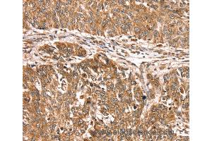 Immunohistochemistry of Human lung cancer using PDLIM4 Polyclonal Antibody at dilution of 1:30 (PDLIM4 anticorps)