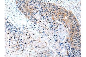 The image on the left is immunohistochemistry of paraffin-embedded Human esophagus cancer tissue using ABIN7190229(CFC1 Antibody) at dilution 1/20, on the right is treated with synthetic peptide. (CFC1 anticorps)