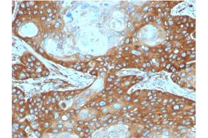 Formalin-fixed, paraffin-embedded human Cervix Carcinoma stained with Laminin Receptor Monospecific Mouse Monoclonal Antibody (RPSA/2699).