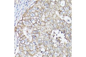 Immunohistochemistry of paraffin-embedded human breast cancer using MCT4/SLC16 Rabbit pAb (ABIN6129472, ABIN6147859, ABIN6147860 and ABIN6214836) at dilution of 1:100 (40x lens). (SLC16A3 anticorps  (AA 371-465))