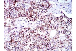 Immunohistochemical analysis of paraffin-embedded prostate cancer tissues using ALCAM mouse mAb with DAB staining.