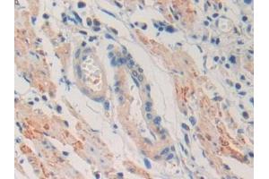 DAB staining on IHC-P; Samples: Human Stomach cancer Tissue