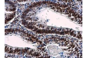 IHC-P Image NuMA antibody [N1], N-term detects NuMA protein at nucleus in human colon carcinoma by immunohistochemical analysis.