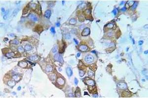 Immunohistochemistry (IHC) analyzes of p-IGF1R antibody in paraffin-embedded human lung adenocarcinoma tissue. (IGF1R anticorps  (pTyr980))