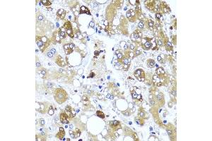 Immunohistochemistry of paraffin-embedded human liver damage using IL4 antibody (ABIN6128137, ABIN6142396, ABIN6142397 and ABIN6221290) at dilution of 1:100 (40x lens). (IL-4 anticorps  (AA 25-153))
