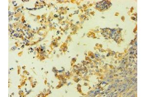 Immunohistochemistry of paraffin-embedded human cervical cancer using ABIN7155116 at dilution of 1:100
