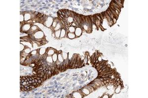 ABIN6269220 showing positive staining in colon cancer tissue.