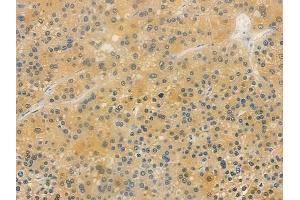 ABIN7096367 and ABIN7100430 at 1/100 staining human hepatocellular carcinoma by IHC-P. (TRIB1 anticorps)