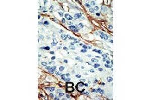 Formalin-fixed and paraffin-embedded human cancer tissue reacted with NUAK1 polyclonal antibody  , which was peroxidase-conjugated to the secondary antibody, followed by DAB staining. (NUAK1 anticorps  (C-Term))