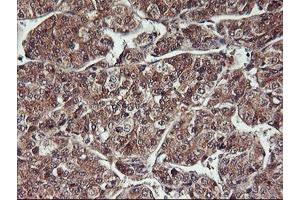 Immunohistochemical staining of paraffin-embedded Carcinoma of Human liver tissue using anti-HDHD1 mouse monoclonal antibody. (HDHD1 anticorps)
