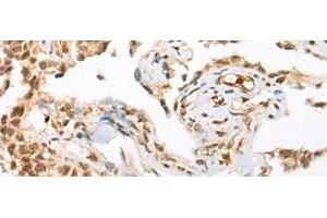 Immunohistochemistry of paraffin-embedded Human ovarian cancer tissue using ATN1 Polyclonal Antibody at dilution of 1:50(x200) (Atrophin 1 anticorps)