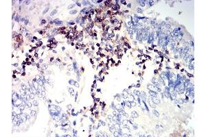 Immunohistochemical analysis of paraffin-embedded endometrial cancer tissues using CD352 mouse mAb with DAB staining. (SLAMF6 anticorps  (AA 22-226))