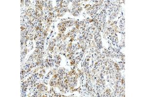 IHC analysis of Fibrinogen Beta Chain/FGB using anti-Fibrinogen Beta Chain/FGB antibody (ABIN4886579). (Fibrinogen beta Chain anticorps  (Middle Region))