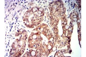 Immunohistochemical analysis of paraffin-embedded rectal cancer tissues using CDX2 mouse mAb with DAB staining. (CDX2 anticorps  (AA 1-180))