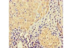 Immunohistochemistry of paraffin-embedded human liver cancer using ABIN7158316 at dilution of 1:100 (LHFPL1 anticorps  (AA 21-85))