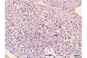 Formalin-fixed and paraffin embedded human colon carcinoma tissue labeled with Anti BACH1/BRIP1 Polyclonal Antibody,Unconjugated (ABIN753718) at 1:200 followed by conjugation to the secondary antibody and DAB staining.