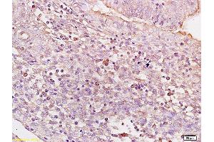 Formalin-fixed and paraffin embedded human colon carcinoma tissue labeled with Anti BACH1/BRIP1 Polyclonal Antibody,Unconjugated (ABIN753718) at 1:200 followed by conjugation to the secondary antibody and DAB staining. (BRIP1 anticorps)