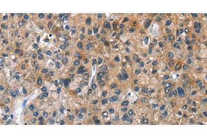 Immunohistochemistry of paraffin-embedded Human liver cancer tissue using BPI Polyclonal Antibody at dilution 1:50 (BPI anticorps)