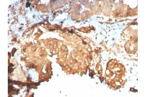 Formalin-fixed, paraffin-embedded human Breast Carcinoma stained with GRP94 Recombinant Rabbit Monoclonal Antibody (HSP90B1/3168R). (Recombinant GRP94 anticorps)