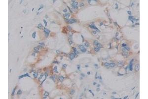 Detection of IL2 in Human Bile duct cancer Tissue using Monoclonal Antibody to Interleukin 2 (IL2) (IL-2 anticorps  (AA 21-153))