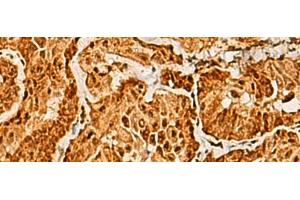 Immunohistochemistry of paraffin-embedded Human thyroid cancer tissue using SAP30BP Polyclonal Antibody at dilution of 1:40(x200) (SAP30BP anticorps)