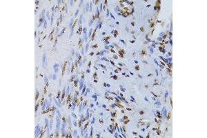 Immunohistochemistry of paraffin-embedded human adenomyosis using XRCC5 Antibody.