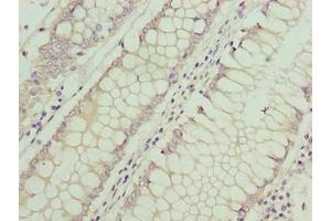 Immunohistochemistry of paraffin-embedded human colon cancer using ABIN7144195 at dilution of 1:100 (ASB7 anticorps  (AA 1-274))
