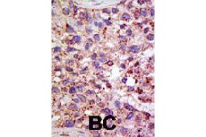 Formalin-fixed and paraffin-embedded human cancer tissue reacted with USP11 polyclonal antibody  , which was peroxidase-conjugated to the secondary antibody, followed by AEC staining .