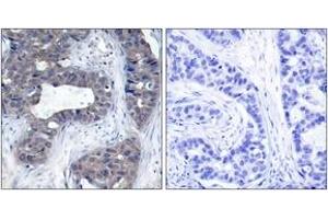 Immunohistochemistry analysis of paraffin-embedded human breast carcinoma tissue, using IRS-1 (Ab-307) Antibody. (IRS1 anticorps  (AA 274-323))