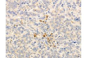 ABIN6264457 and ABIN6272976 at 1/100 staining Human breast cancer by IHC-P. (PSAT1 anticorps  (Internal Region))