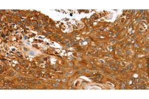 Immunohistochemistry of paraffin-embedded Human esophagus cancer tissue using ABCC8 Polyclonal Antibody at dilution 1:40 (ABCC8 anticorps)