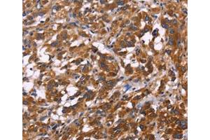 Immunohistochemical analysis of paraffin-embedded Human thyroid cancer tissue using at dilution 1/30. (KIR2DL3 anticorps  (Internal Region))