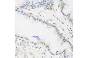 Immunohistochemistry of paraffin-embedded human stomach using IGF2BP3 antibody (ABIN5972501) at dilution of 1/200 (40x lens). (IGF2BP3 anticorps)