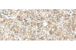 Immunohistochemistry of paraffin-embedded Human liver cancer tissue using PAPSS2 Polyclonal Antibody at dilution of 1:95(x200)