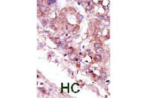 Formalin-fixed and paraffin-embedded human hepatocellular carcinoma tissue reacted with STK33 polyclonal antibody  , which was peroxidase-conjugated to the secondary antibody, followed by DAB staining. (STK33 anticorps  (C-Term))
