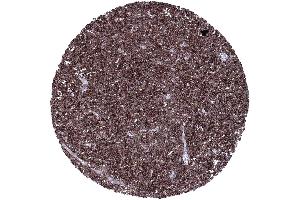 B cell chronic lymphatic leukemia B CLL composed of strongly CD23 positive tumor cells