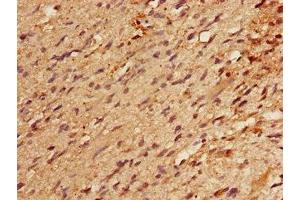 Immunohistochemistry of paraffin-embedded human glioma using ABIN7164177 at dilution of 1:100