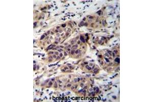 WDR42C Antibody (N-term) immunohistochemistry analysis in formalin fixed and paraffin embedded human breast carcinoma followed by peroxidase conjugation of the secondary antibody and DAB staining. (DCAF8L2 anticorps  (N-Term))