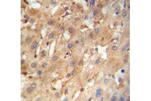 NEU4 antibody immunohistochemistry analysis in formalin fixed and paraffin embedded human hepatocarcinoma.