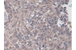 Detection of NAGLU in Human Lung cancer Tissue using Polyclonal Antibody to N-Acetyl Alpha-D-Glucosaminidase (NAGLU)