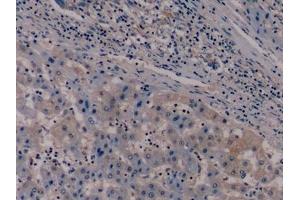 Detection of NES in Human Liver cancer Tissue using Monoclonal Antibody to Nestin (NES)