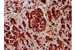 IHC image of ABIN7168793 diluted at 1:400 and staining in paraffin-embedded human pancreatic cancer performed on a Leica BondTM system.