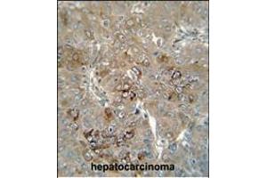 CES4 antibody (N-term) (ABIN654667 and ABIN2844363) immunohistochemistry analysis in formalin fixed and paraffin embedded human hepatocarcinoma followed by peroxidase conjugation of the secondary antibody and DAB staining. (CES1P1 anticorps  (N-Term))