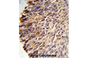 Formalin-fixed and paraffin-embedded human lung carcinoma reacted with BCL3 Antibody (Center), which was peroxidase-conjugated to the secondary antibody, followed by DAB staining. (BCL3 anticorps  (Middle Region))