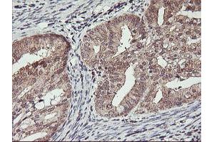 Immunohistochemical staining of paraffin-embedded Adenocarcinoma of Human endometrium tissue using anti-HLCS mouse monoclonal antibody. (HLCS anticorps)
