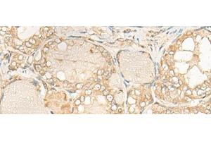 Immunohistochemistry of paraffin-embedded Human thyroid cancer tissue using DUSP27 Polyclonal Antibody at dilution of 1:50(x200) (DUSP27/STYXL2 anticorps)